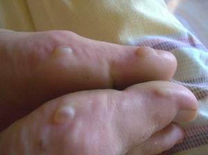 Blisters